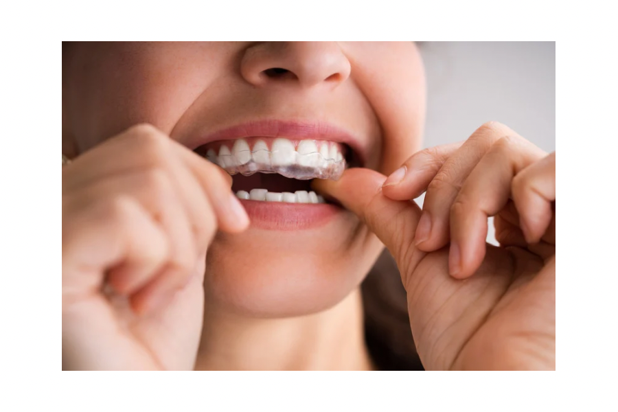 Dental Genie: Professionally Crafted-Custom Dental Night Guard Kit