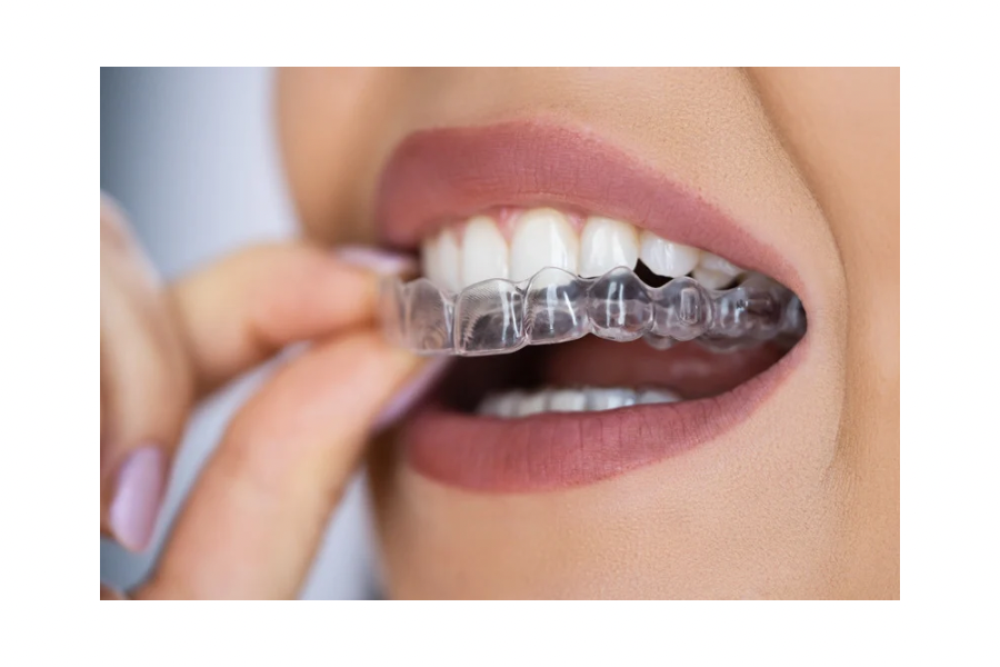 Dental Genie: Professionally Crafted-Custom Dental Night Guard Kit